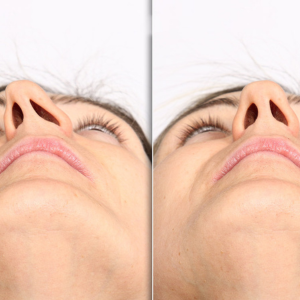 Deviated Septum: Symptoms, Diagnosis & Septoplasty Surgery Explained